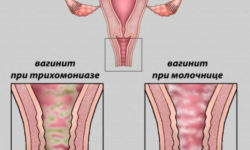 Острый вагинит — что это, причины, симптомы, диагностика, лечение