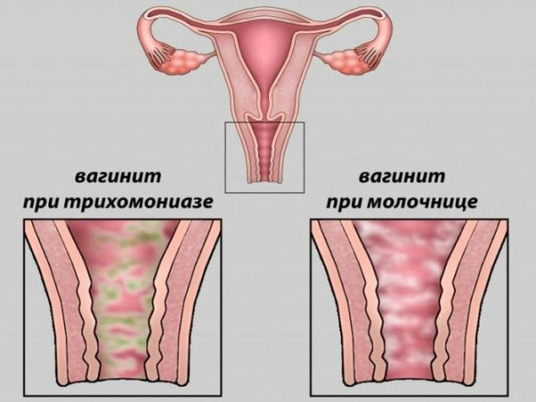 Острый вагинит — что это, причины, симптомы, диагностика, лечение